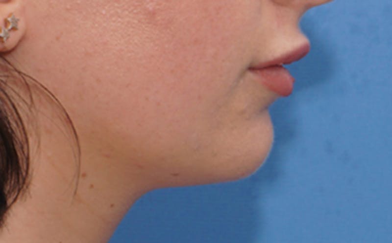 Chin Surgery Before & After Gallery - Patient 105802 - Image 1