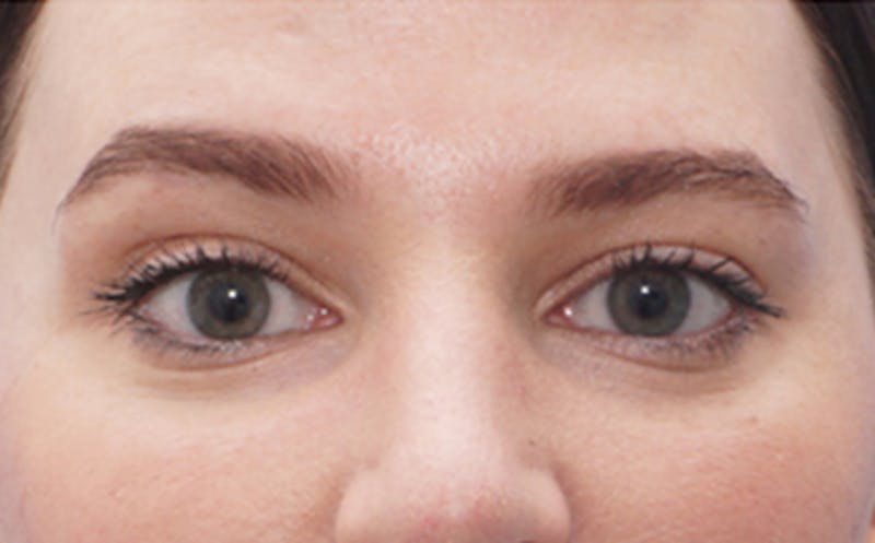 BOTOX Before & After Gallery - Patient 406834 - Image 6