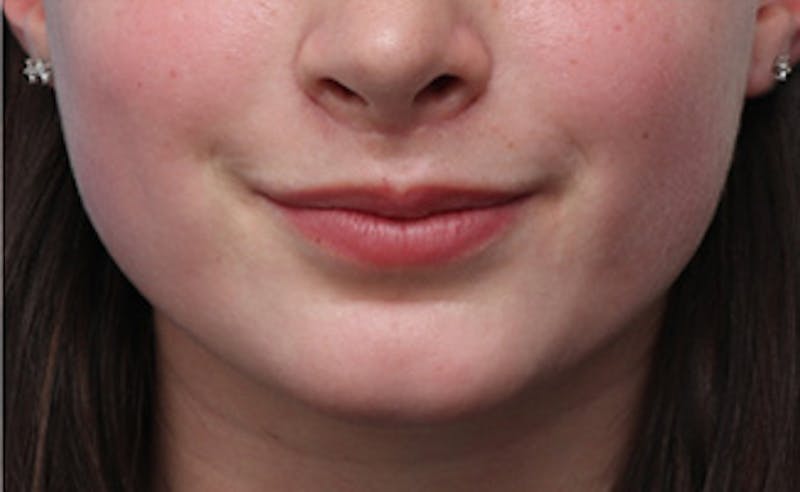 Lip Enhancement Before & After Gallery - Patient 164524 - Image 2
