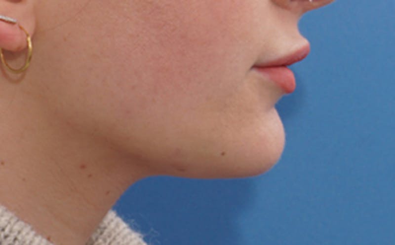 Chin Surgery Before & After Gallery - Patient 105802 - Image 2