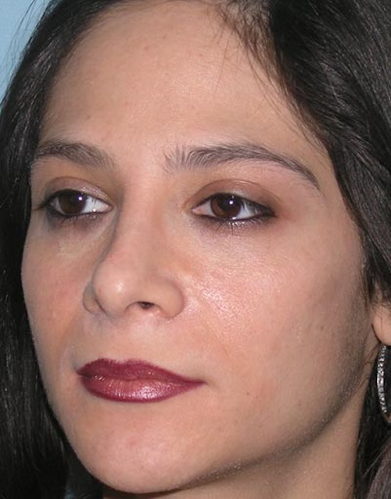 Rhinoplasty  Before & After Gallery - Patient 286006 - Image 4