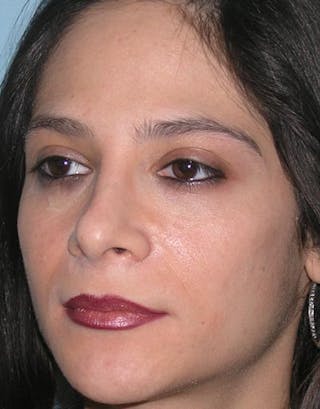 Rhinoplasty Before & After Gallery - Patient 286006 - Image 4