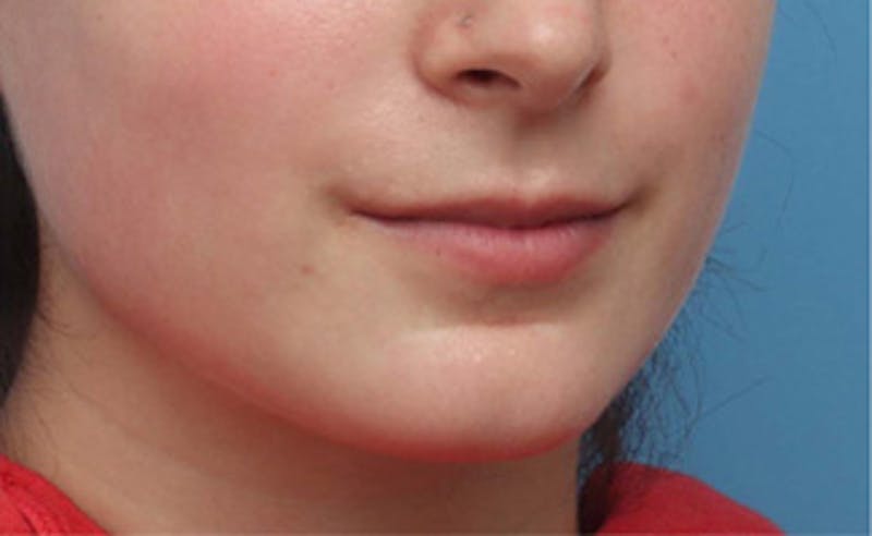 Lip Fillers Before & After Gallery - Patient 164524 - Image 3