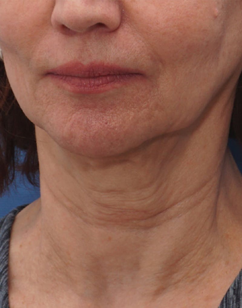 BOTOX Before & After Gallery - Patient 128126 - Image 1