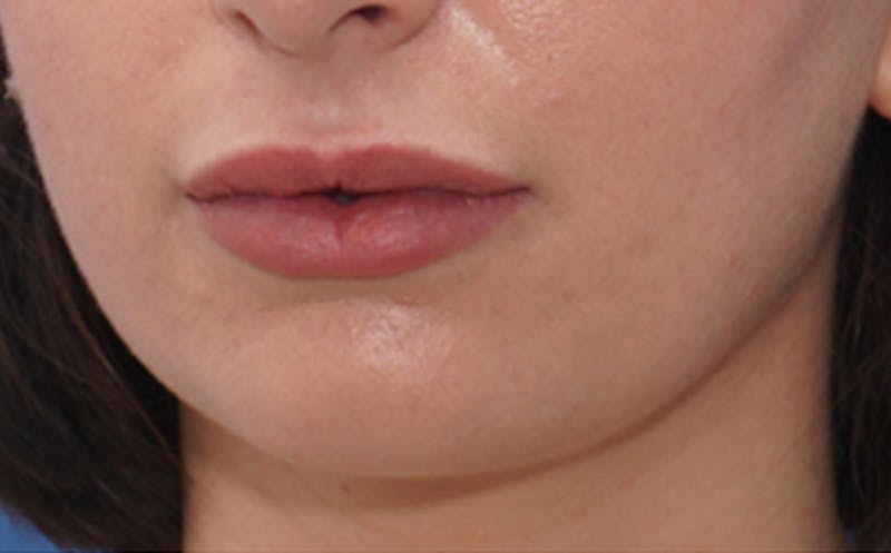 Chin Surgery Before & After Gallery - Patient 105802 - Image 3