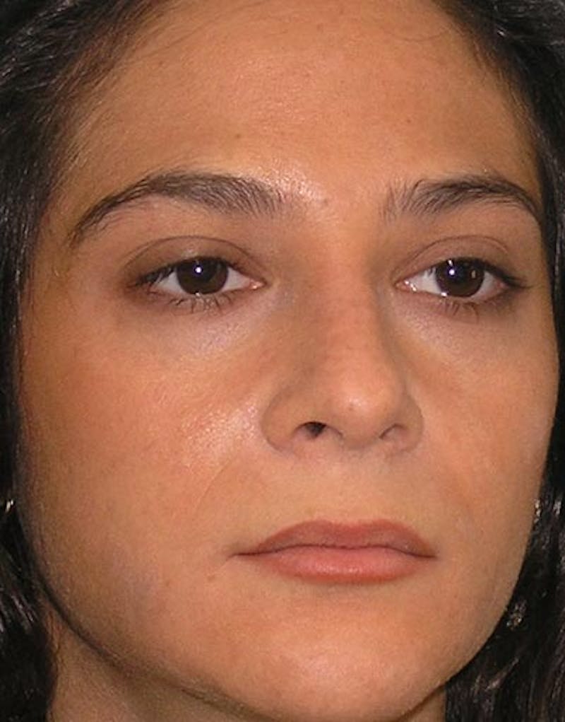 Rhinoplasty Before & After Gallery - Patient 143589 - Image 3