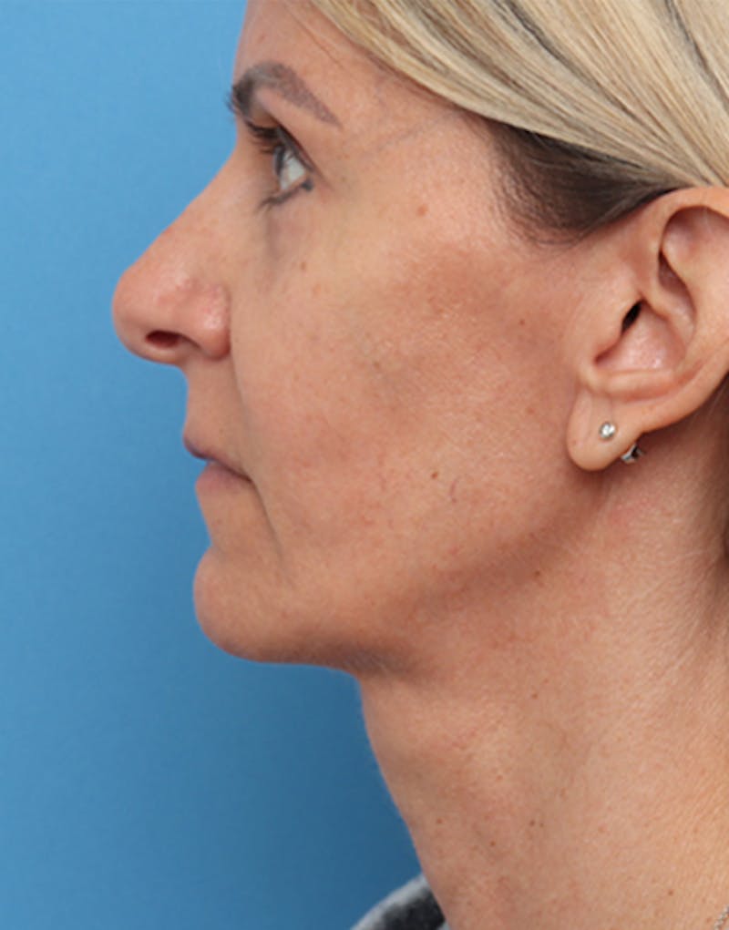 FaceTite Before & After Gallery - Patient 301341 - Image 6