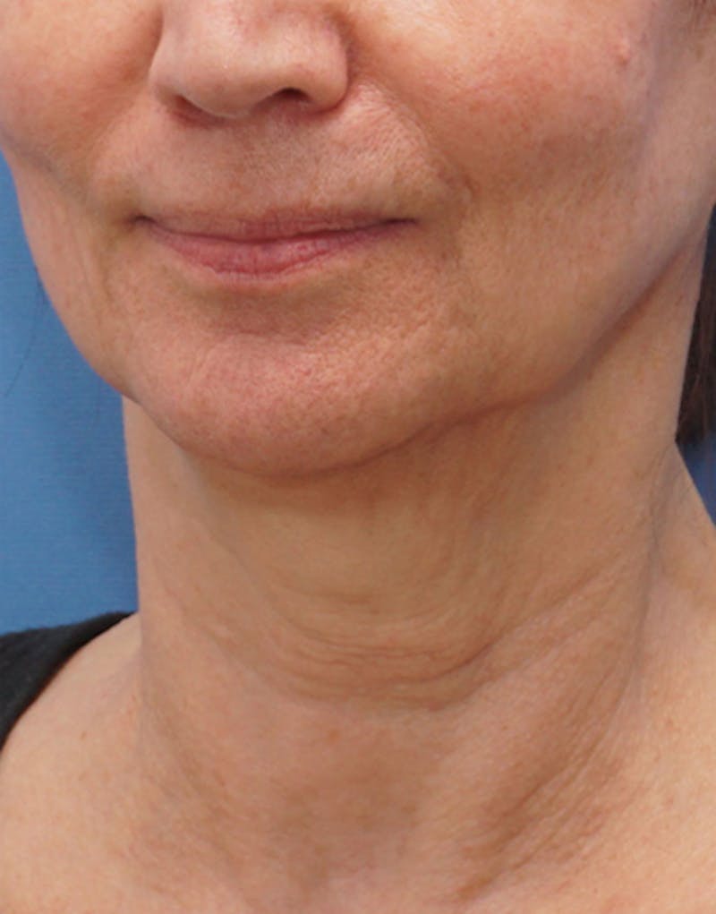 BOTOX Before & After Gallery - Patient 128126 - Image 2