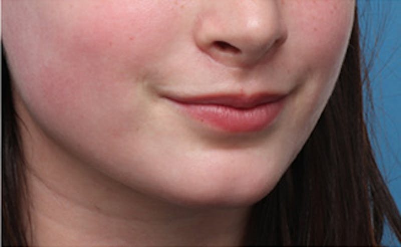 Lip Fillers Before & After Gallery - Patient 164524 - Image 4