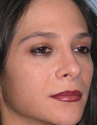 Rhinoplasty Before & After Gallery - Patient 286006 - Image 6