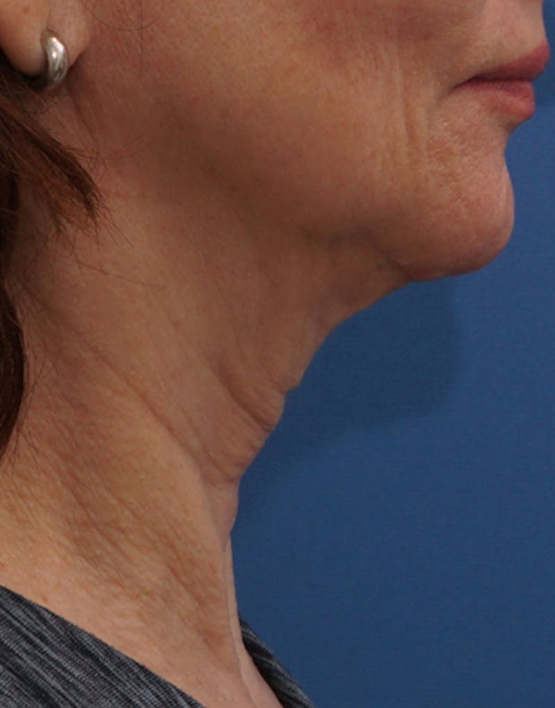 BOTOX Before & After Gallery - Patient 128126 - Image 3