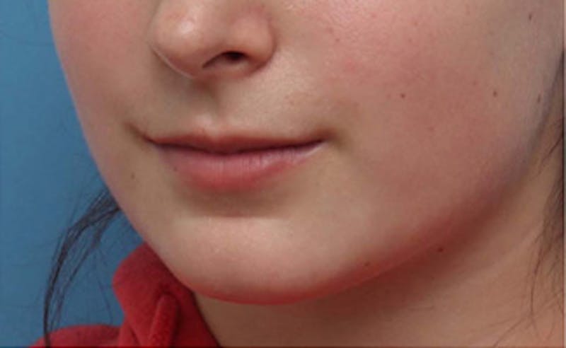 Lip Fillers Before & After Gallery - Patient 164524 - Image 5