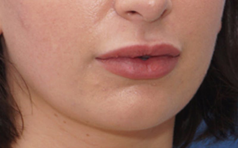 Chin Surgery Before & After Gallery - Patient 105802 - Image 5
