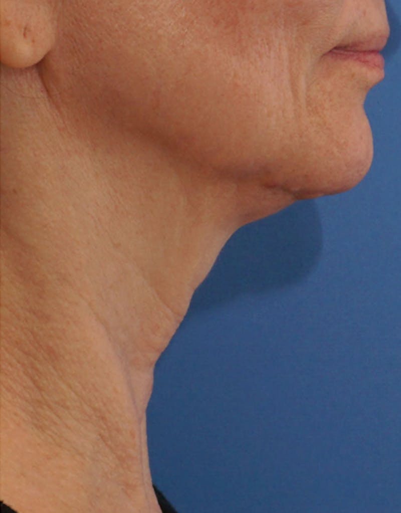 BOTOX Before & After Gallery - Patient 128126 - Image 4
