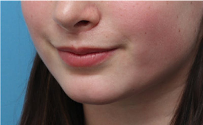 Lip Fillers Before & After Gallery - Patient 164524 - Image 6