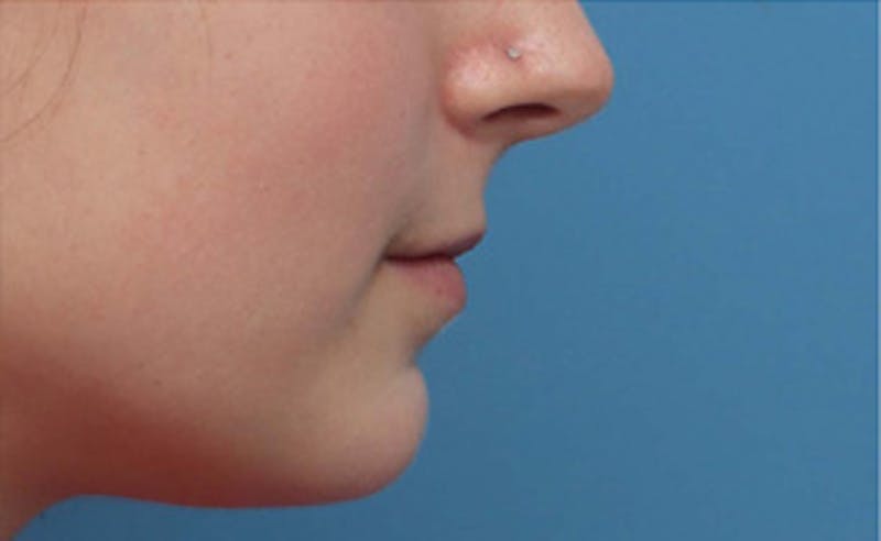 Lip Fillers Before & After Gallery - Patient 164524 - Image 7