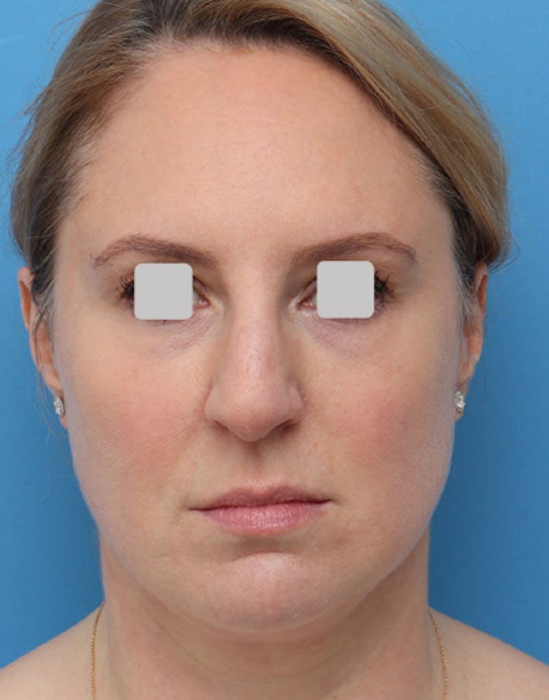 Patient OU_dN9pIRIGPu4Ruwdn3Bg - FaceTite Before & After Photos