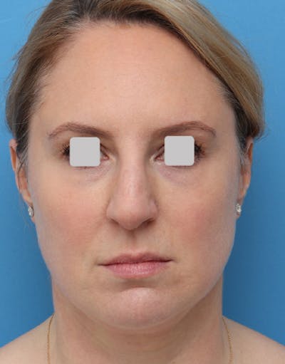 FaceTite Before & After Gallery - Patient 274484 - Image 1