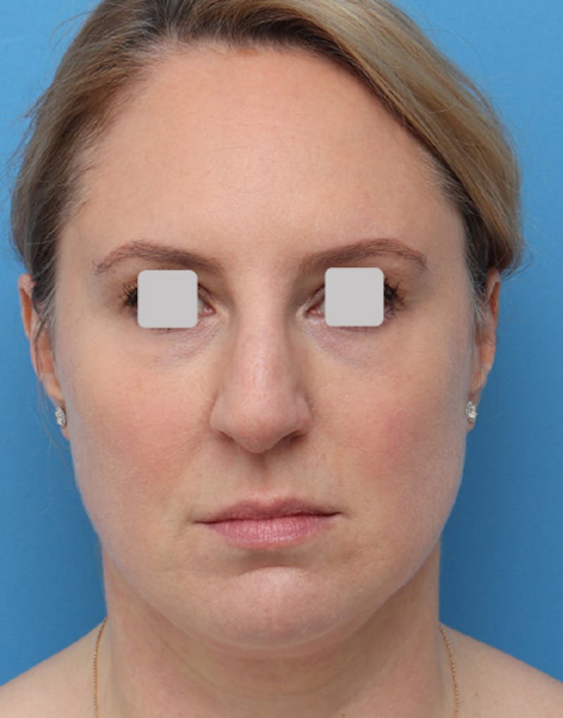 FaceTite Before & After Gallery - Patient 274484 - Image 1