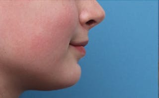 Lip Fillers Before & After Gallery - Patient 164524 - Image 8