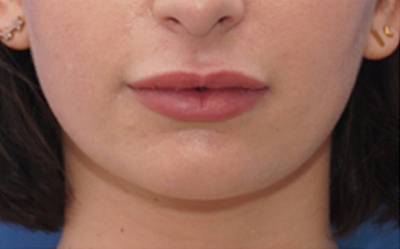 Chin Surgery Before & After Gallery - Patient 105802 - Image 7