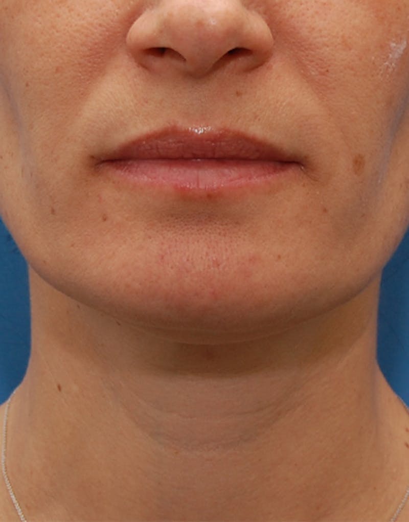 Patient djChuEJhRJme72_AKaYm7g - Fillers Before & After Photos