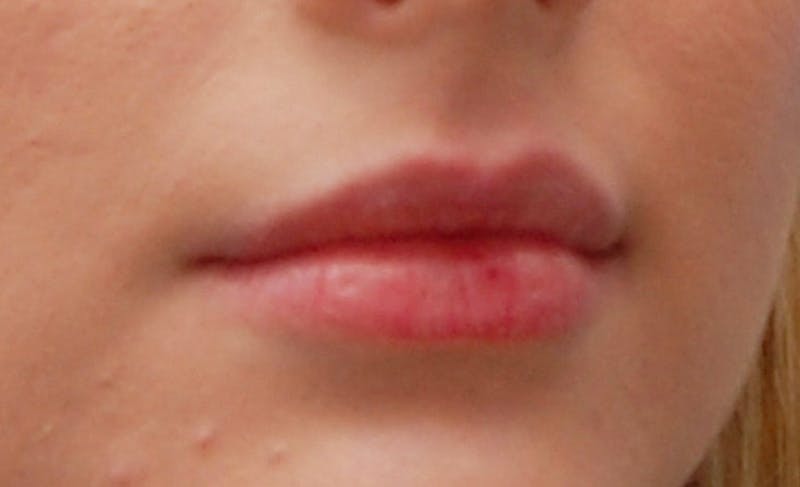 Lip Fillers Before & After Gallery - Patient 388477 - Image 1