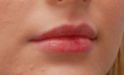 Lip Fillers Before & After Gallery - Patient 388477 - Image 1
