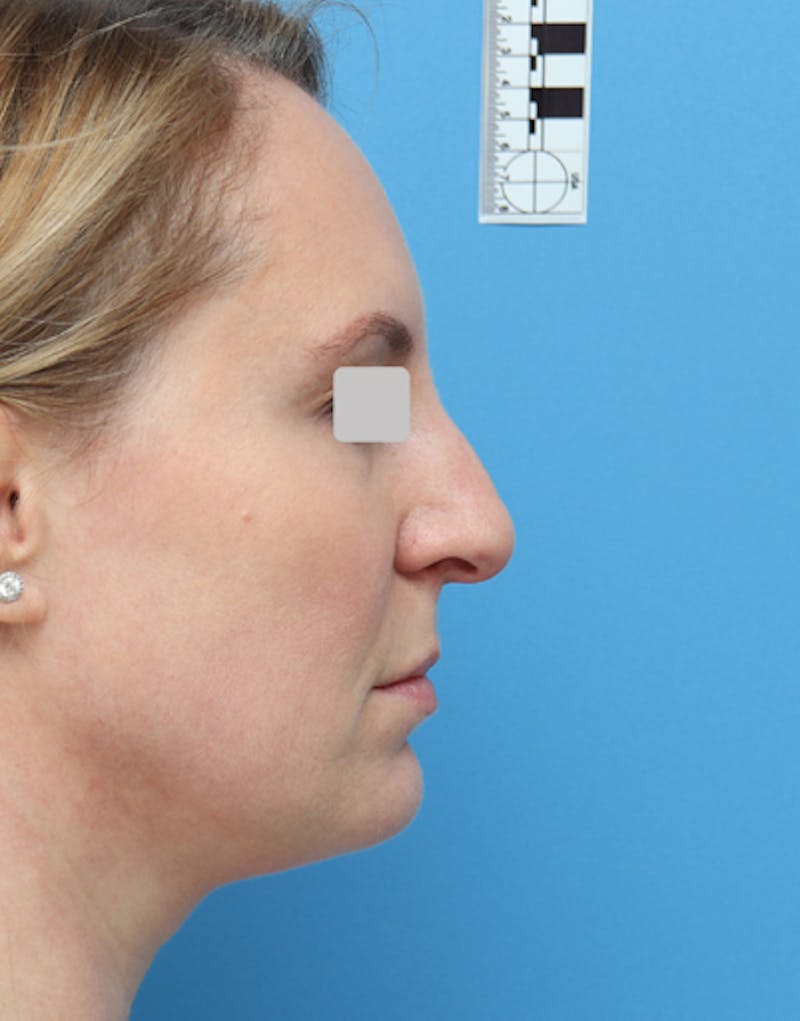 FaceTite Before & After Gallery - Patient 274484 - Image 3
