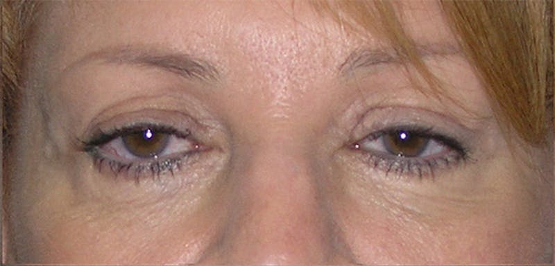 Patient LuUbCRzYS-uy5rgjjJTnVA - Eyelid Surgery Before & After Photos