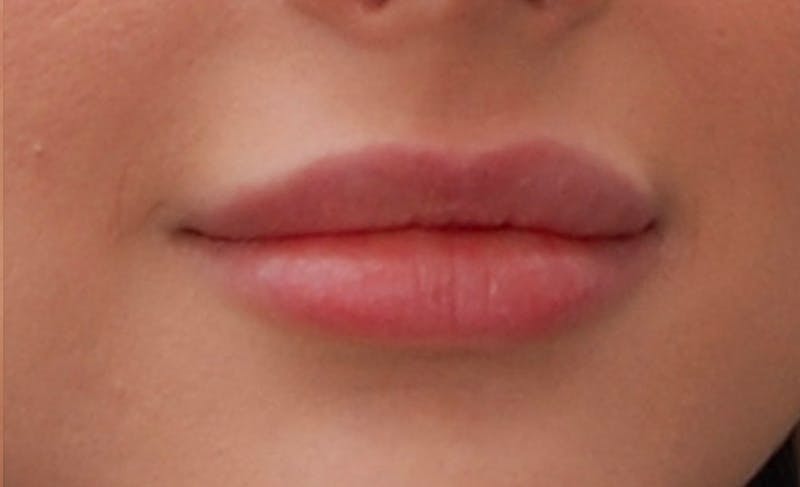 Lip Fillers Before & After Gallery - Patient 388477 - Image 2