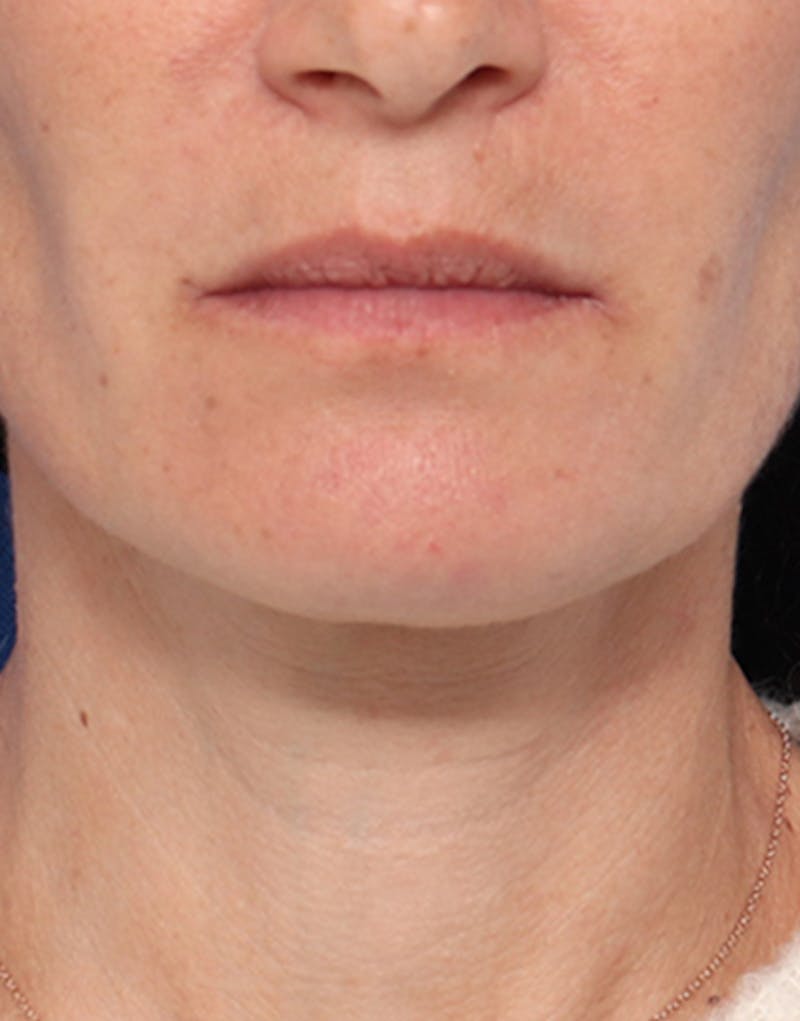 Fillers Before & After Gallery - Patient 203787 - Image 2