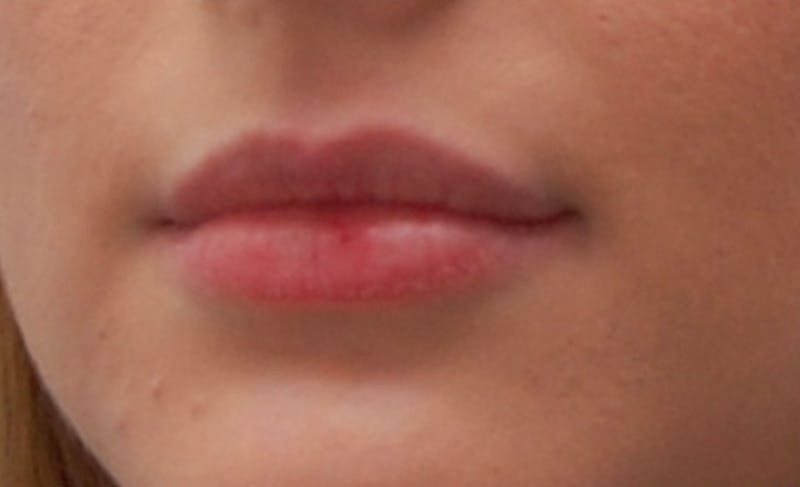 Lip Fillers Before & After Gallery - Patient 388477 - Image 3