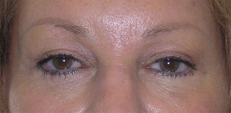 Eyelid Surgery Before & After Gallery - Patient 317197 - Image 2