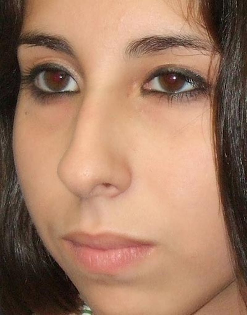 Rhinoplasty  Before & After Gallery - Patient 175026 - Image 5
