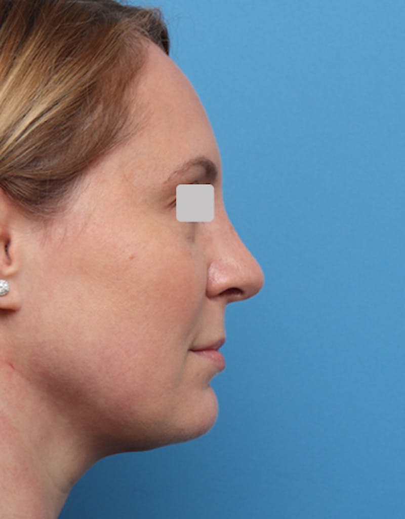 FaceTite Before & After Gallery - Patient 274484 - Image 4