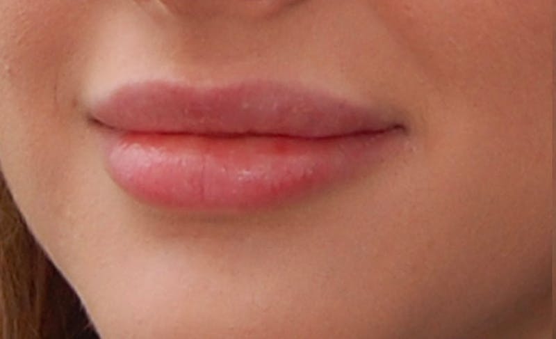 Lip Fillers Before & After Gallery - Patient 388477 - Image 4