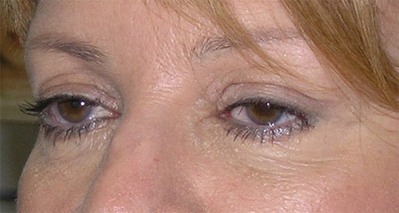 Eyelid Surgery Before & After Gallery - Patient 317197 - Image 3