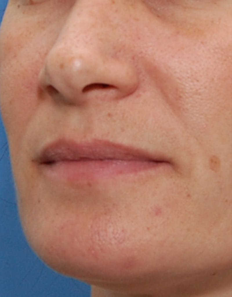 Fillers Before & After Gallery - Patient 203787 - Image 3