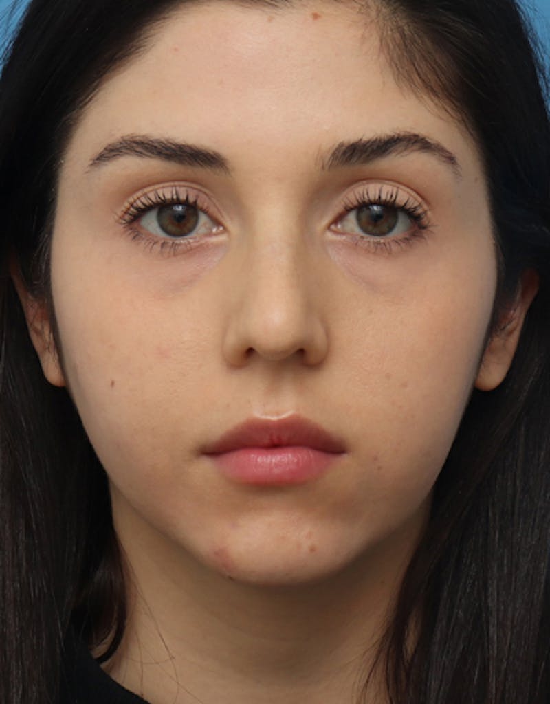 FaceTite Before & After Gallery - Patient 312157 - Image 1