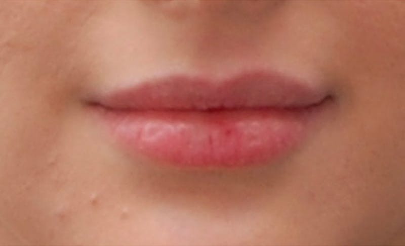 Lip Fillers Before & After Gallery - Patient 388477 - Image 5