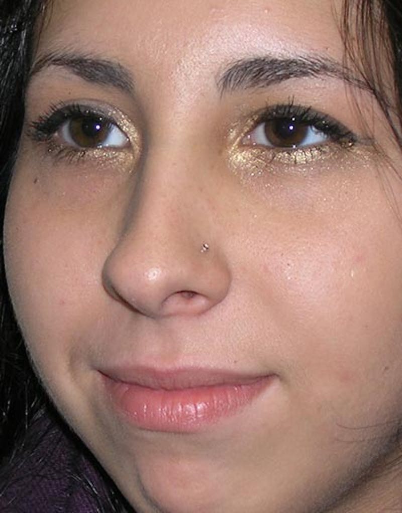 Rhinoplasty Before & After Gallery - Patient 386748 - Image 2