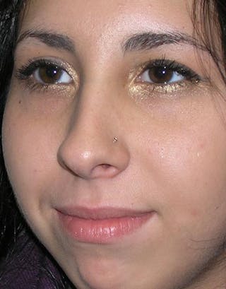 Rhinoplasty Before & After Gallery - Patient 175026 - Image 6