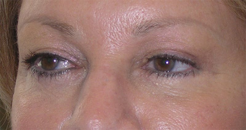 Eyelid Surgery Before & After Gallery - Patient 317197 - Image 4