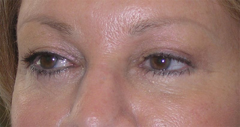 Eyelid Surgery Before & After Gallery - Patient 317197 - Image 4
