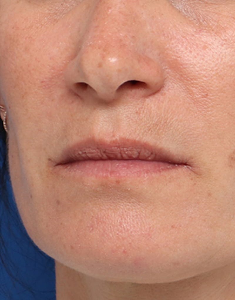 Fillers Before & After Gallery - Patient 203787 - Image 4