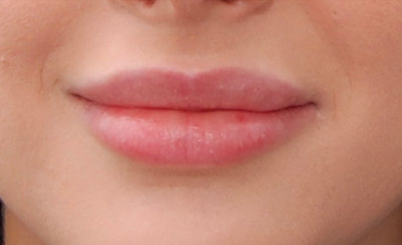 Lip Fillers Before & After Gallery - Patient 388477 - Image 6