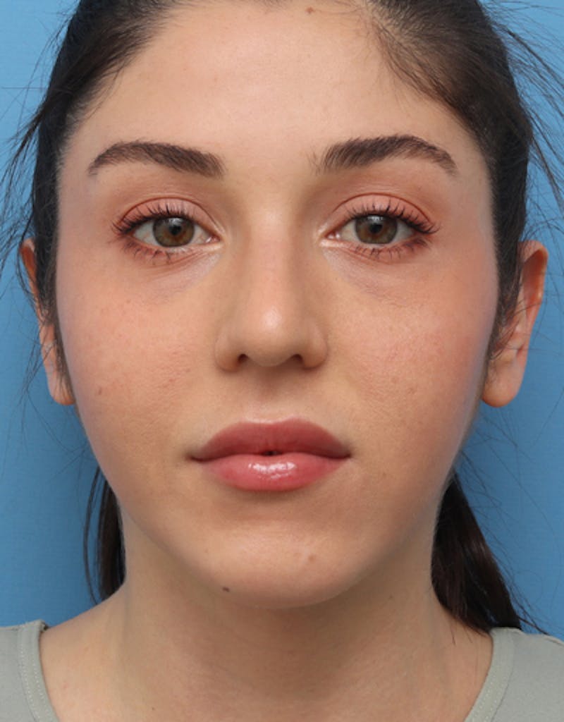 FaceTite Before & After Gallery - Patient 312157 - Image 2
