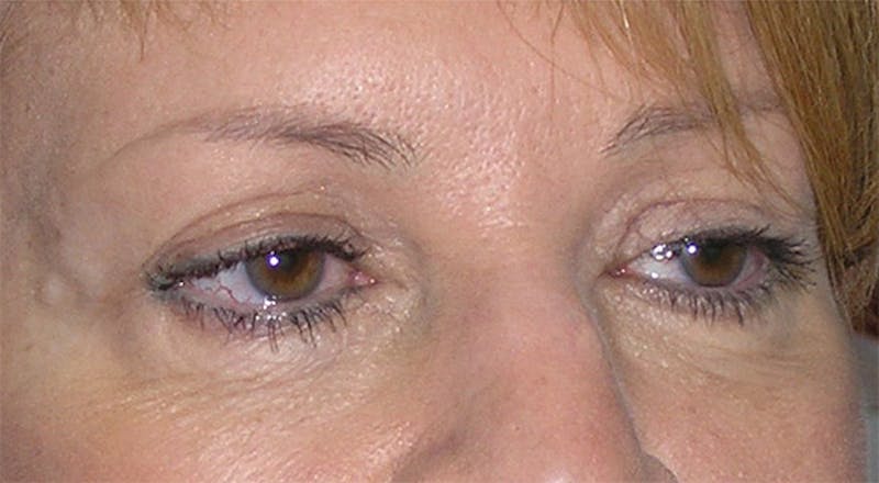 Eyelid Surgery Before & After Gallery - Patient 317197 - Image 5