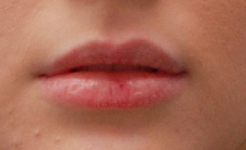 Lip Fillers Before & After Gallery - Patient 388477 - Image 7